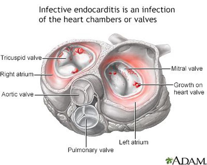 Causes of endocarditis