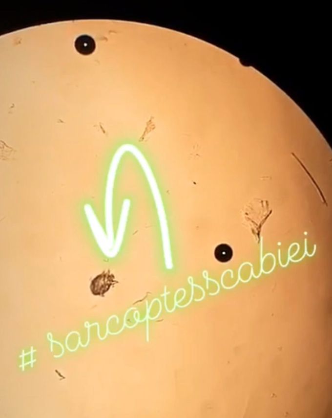Don’t miss scabies!