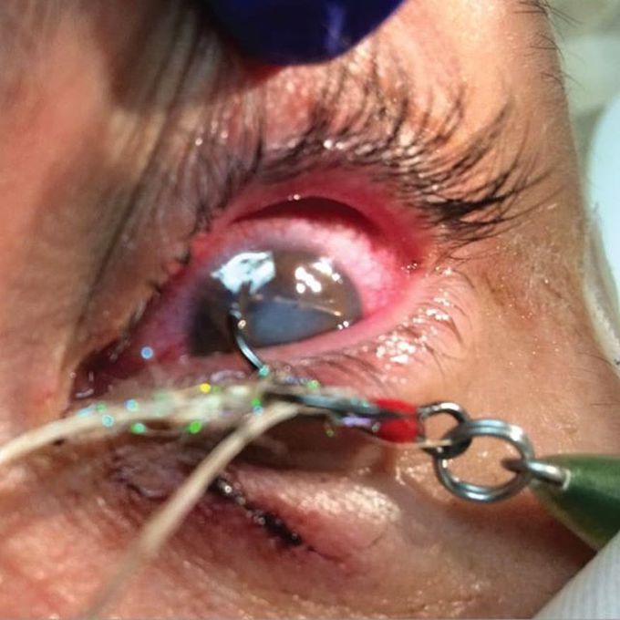 Penetrating Ocular Fishhook Injury! 