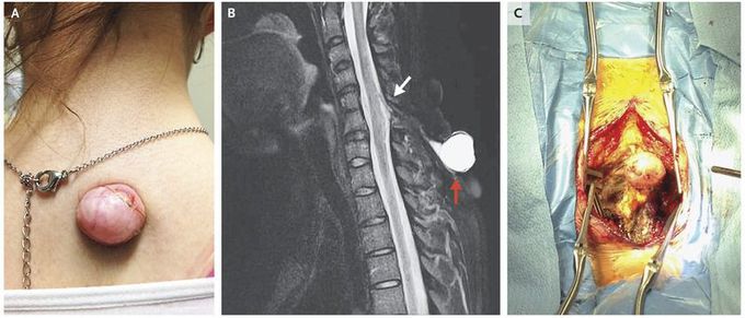 Cervical Meningocele