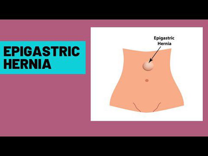 Epigastric Hernia: Overview