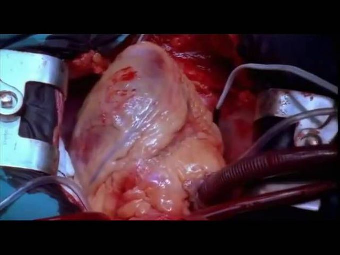 Live Beating Heart and Heart Surgery