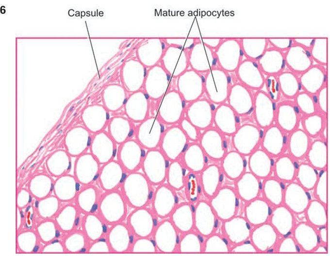 Lipoma