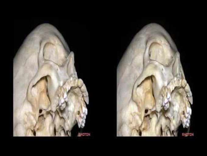 Orbitozygomatic Approaches (3D TV)