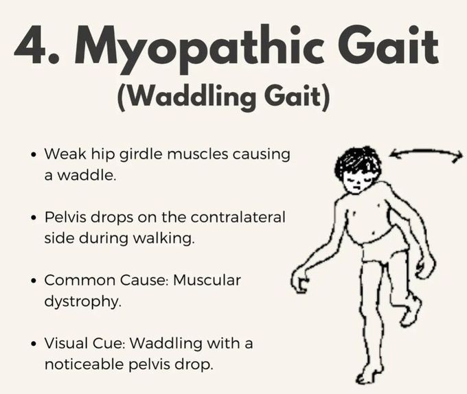 Myopathic Gait