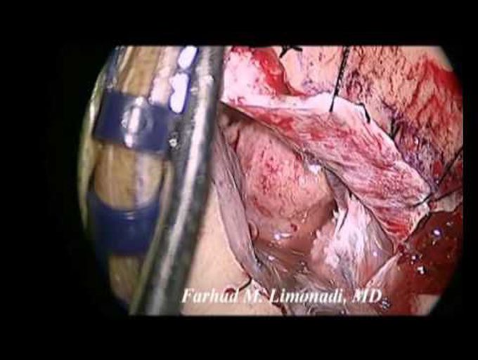 Surgery Metastatic Lung Cancer to Brain