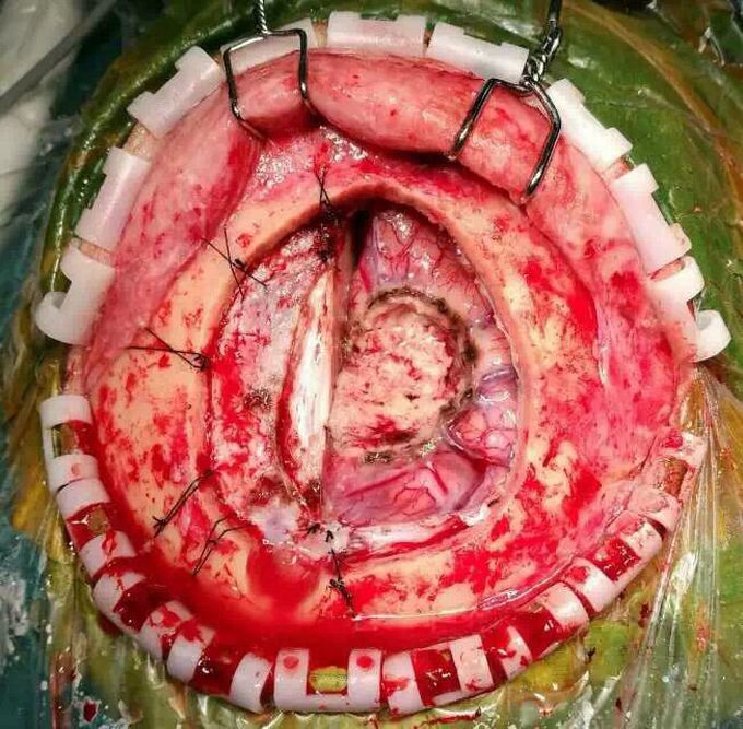 Neurosurgery