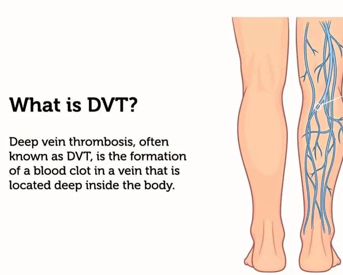 What is DVT?