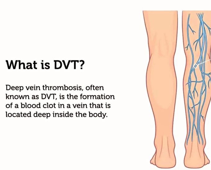 What is DVT?