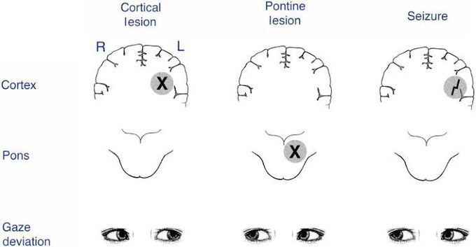 Gaze deviation in Neurological lesion