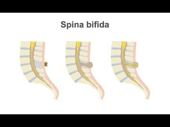 Spina Bifida-Neural Tube Defect (classification and management)