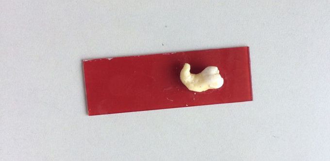 which is development disturbance of tooth in this pic..