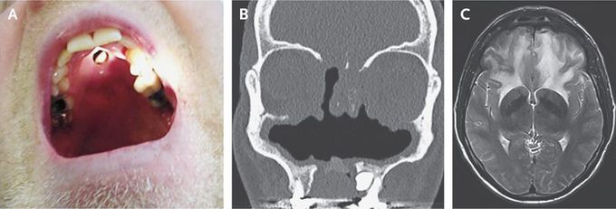 Midline Destructive Lesions in a Cocaine User