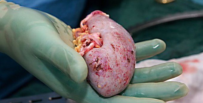 Kidney