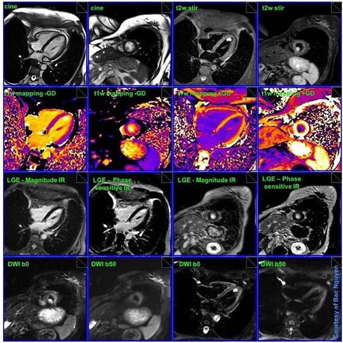 Cardiac tumor CMR