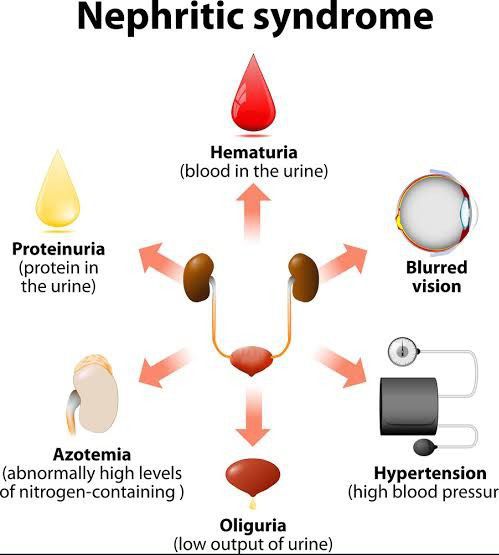 Nephrotic syndrome - MEDizzy