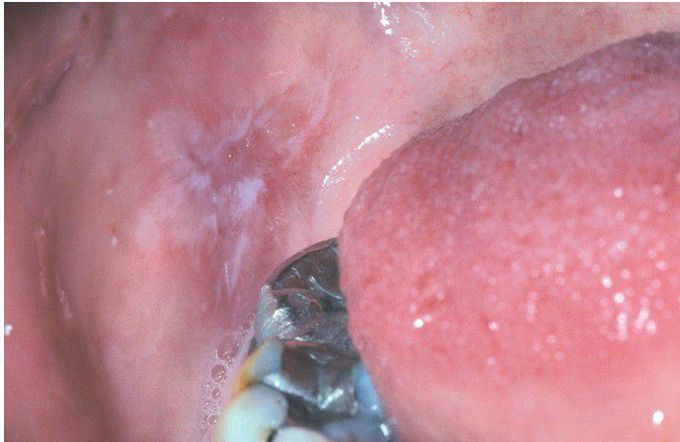 Oral Mucosal Contact Reaction to Dental Amalgam