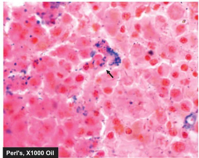 Sideroblastic anaemia