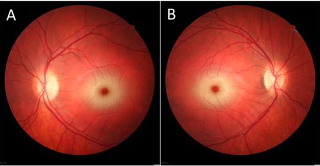 Cherry-Red Spot in Tay–Sachs Disease