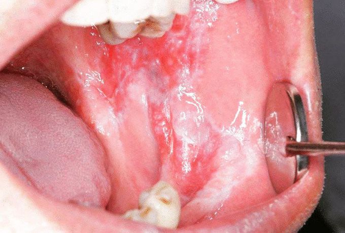 The typical erosive lesion of patients with oral lichen planus
.
Oral lichen planus (OLP) is a chronic inflammatory disease that affects the mucus membrane of the oral cavity. Oral lichen planus may appear as white, lacy patches; red, swollen tissues; or open sores. These lesions may cause burning, pain or other discomfort.