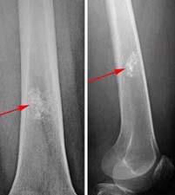 Treatment of Enchondroma