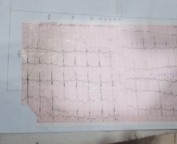 ECG waves