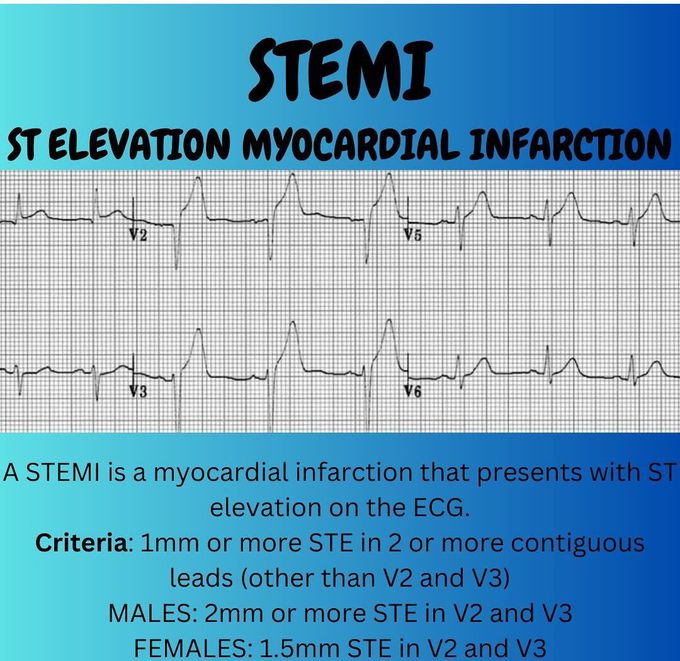 STEMI