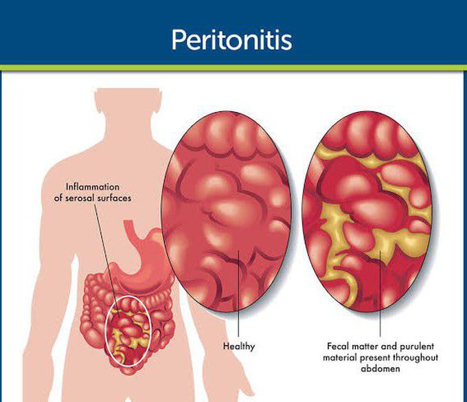 Peritonitis