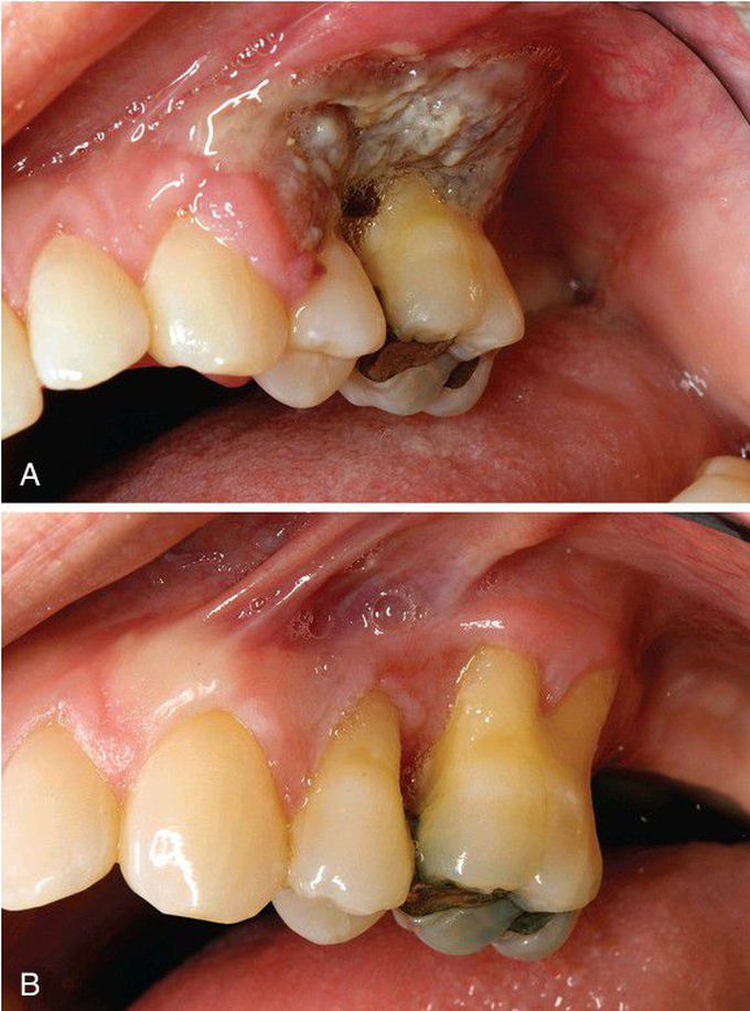 Epstein-Barr Virus (EBV)-Associated Lymphoproliferative Disorder