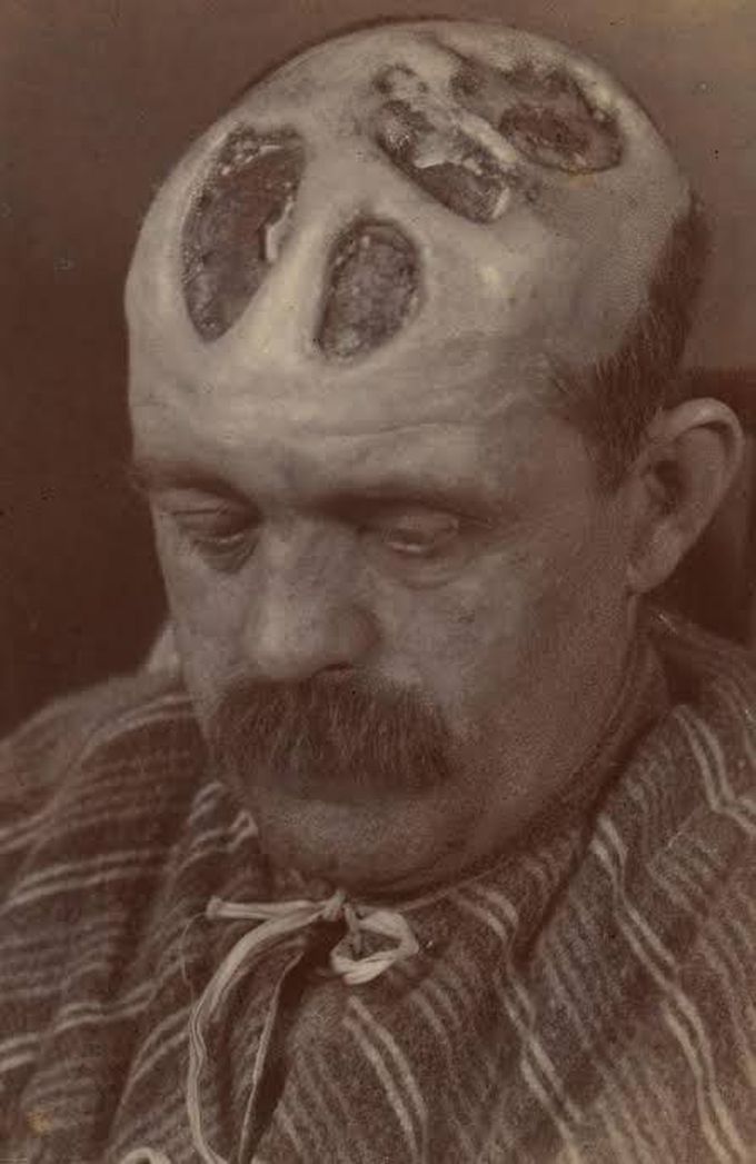 Syphilis