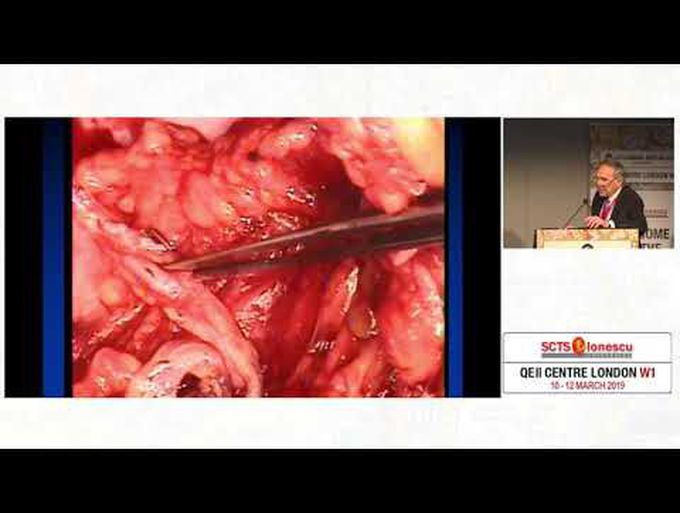 How to Use and Deploy the Radial Artery in Coronary Surgery