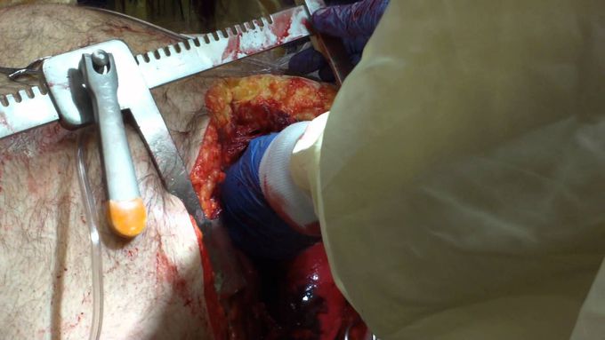 Open Thoracotomy