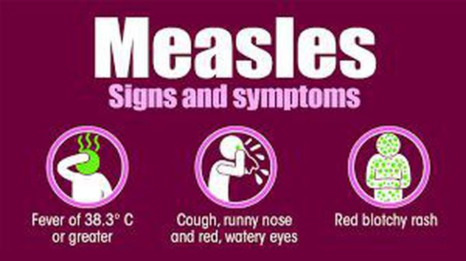 Measles
