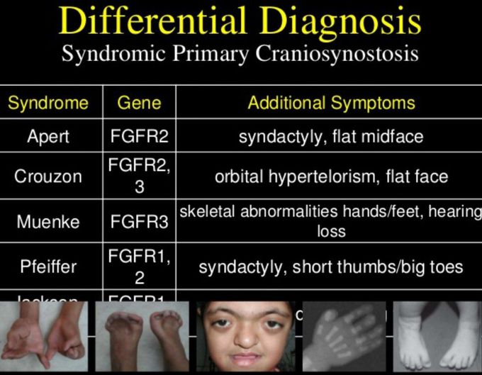 Syndromic Craniosynostosis- Differentials