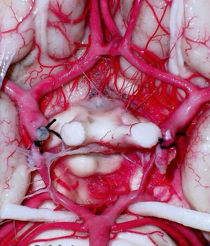 #circle of willis
