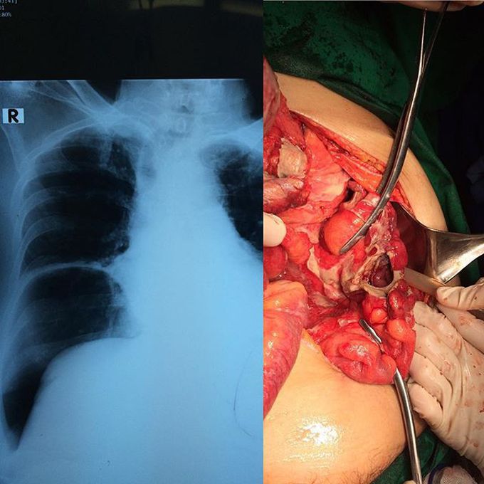 Colonic perforation, note the free air under the right hemidiaphragm