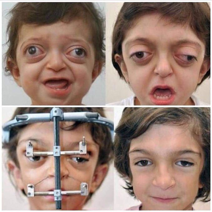 🌿fixed Craniofacial  stenosis associated with crouzon’s syndrome 🤯