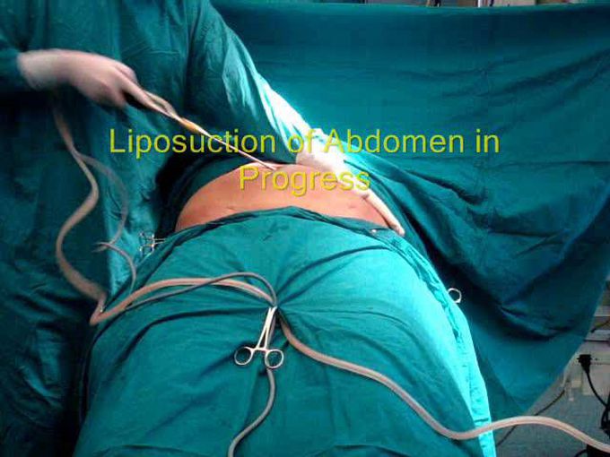 Best liposuction surgery delhi, best fat removal surgery delhi, best liposuction delhi