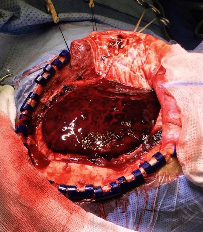 Subarachnoid hemorrhage