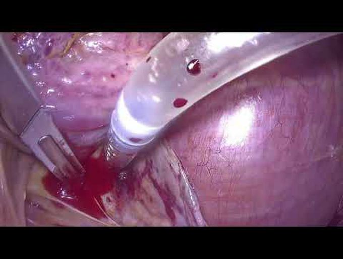 Totally Endoscopic Transaortic Septal Myectomy for Hypertrophic Cardiomyopathy