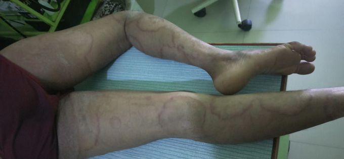 A patient came to hospital with round patchy. Red lessions ,what is it ;&whats the diagnosis 🤔🤔🤔