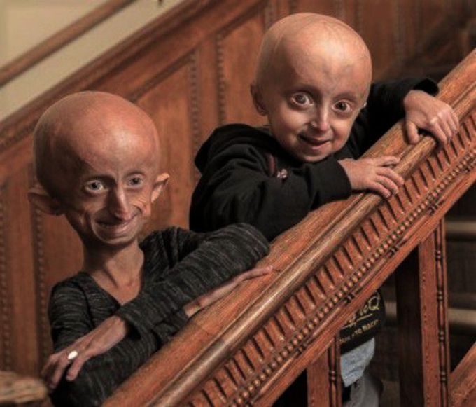 Hutchinson-Gilford Syndrome