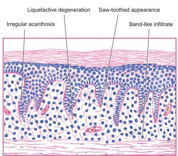 Lichen planus.