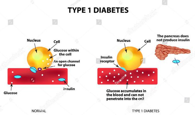 What Can You Not Do If You Have Type 1 Diabetes