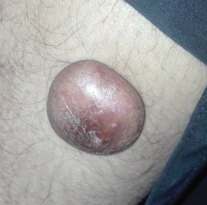 Keloid
