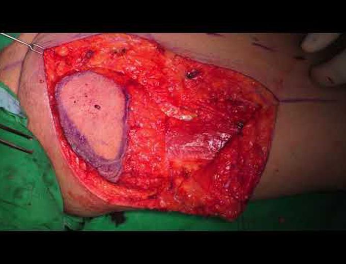 Tug flap for total glossectomy