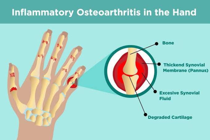 Inflammatory Osteoarthritis in hand