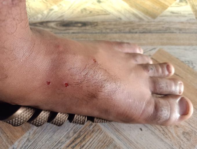 Insect bite