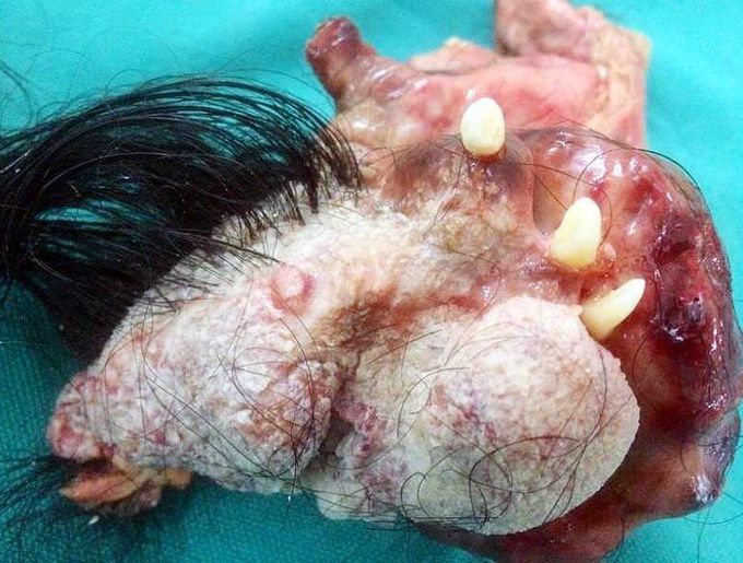 ovarian cyst with hair and teeth