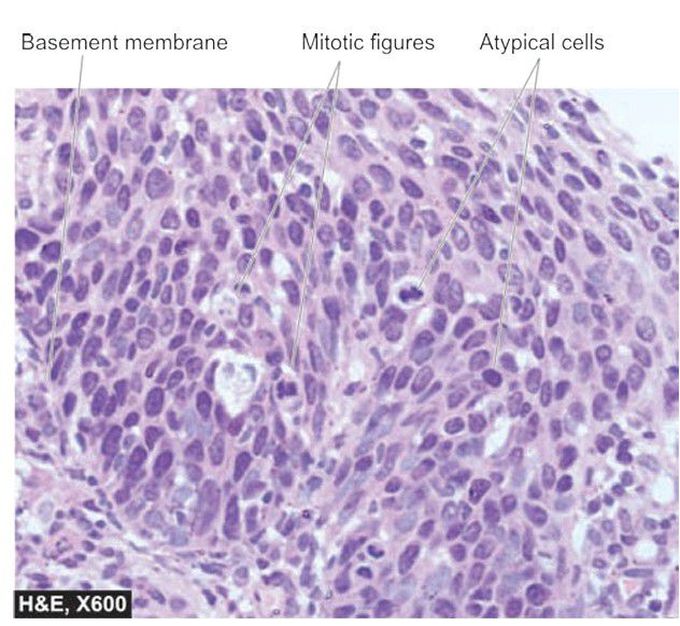 Carcinoma in situ of uterine cervix.